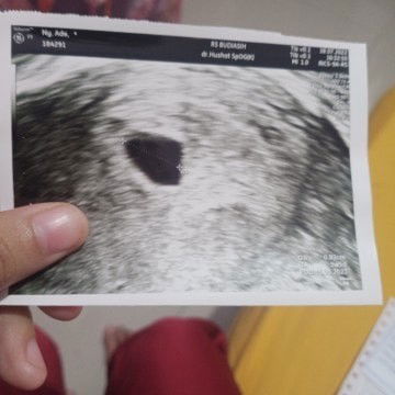 Kehilangan kehamilan pertama