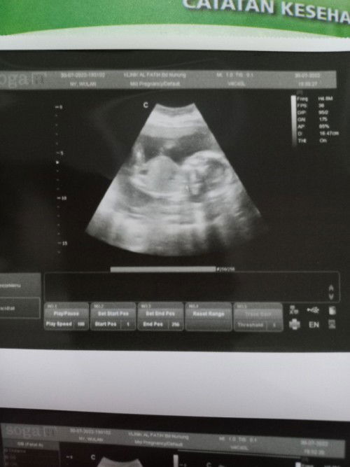 Alhamdulillah hamil 18 w 1d