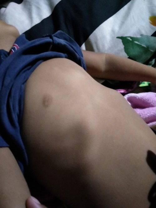 tanong lang po normal po ba na may nakaumbok sa dibdib ng anak ko sa gitna ng checst nya 3 yrs old n