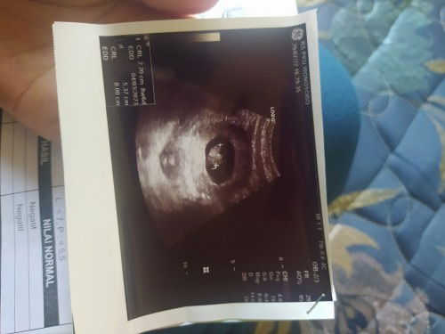 Usg sama bidan bedaa