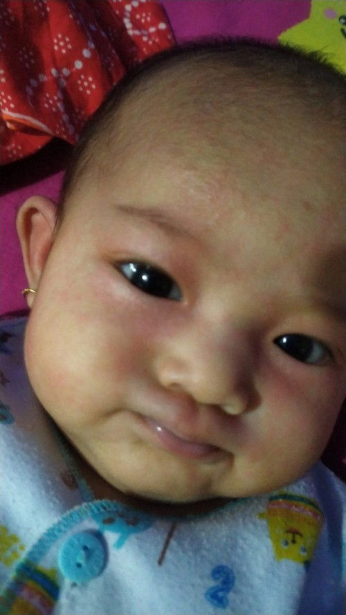 Beruntusan pada bayi 3 bulan