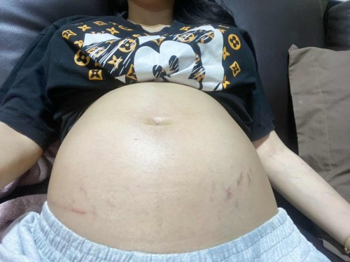 24 สัปดาห์ ท้องแตกลาย