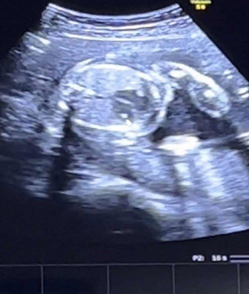น้อง 22 สัปดาห์ซาวเจอแคลเซียมเกาะที่หัวใจ มีคุณแม่บ้านไหนเจอปหแบบนี้ไหมคะ