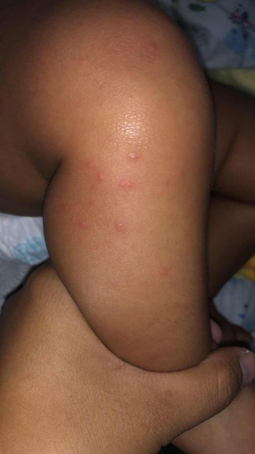 Bintik merah pada bayi 3 bulan