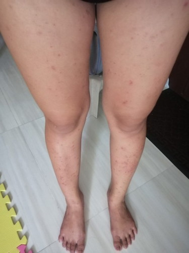 Rashes during pregnancy