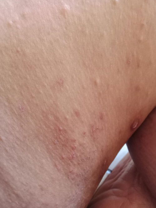 Obat gatal yang ampuh ?