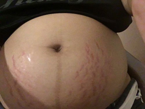 ท้องแตกลาย แม่ๆมีครีมไรแนะนำมั้ยค่า