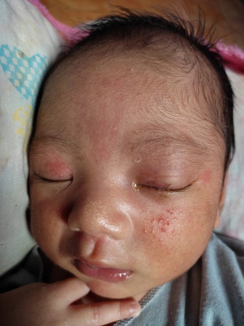 Ruam pipi baby