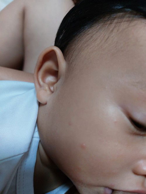 ตุ่มหัวเเข็งเป็นหลายวันไม่หาย