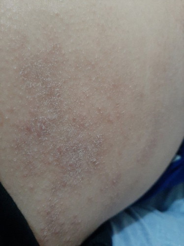 Rashes 14 weeks