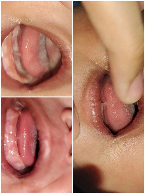 Tongue tie 1½month