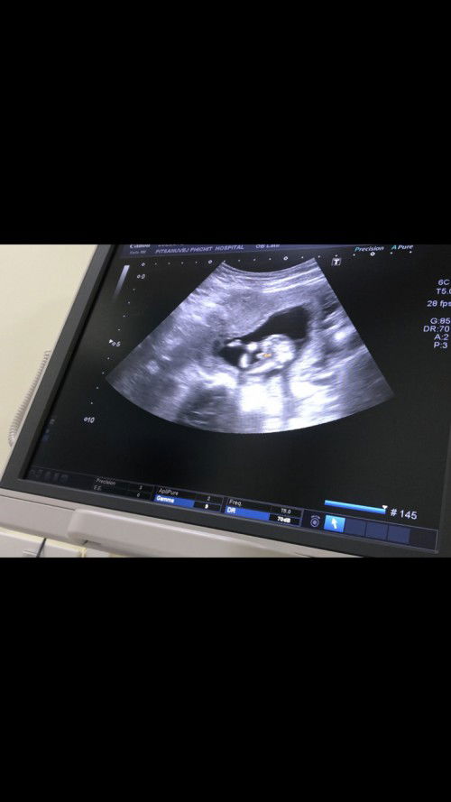 การคัดกรองดาวซินโดม