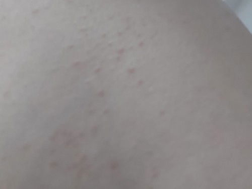 มีแม่ๆบ้านน้องท้องแล้วมีเหมือนผืนแดงขึ้นตามหน้าอกและบริเวณหลังไหมคะ?