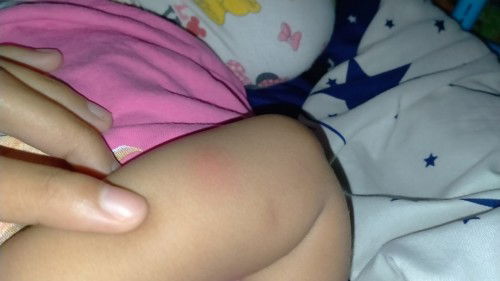 ลูกมีตุ่มเเดงใหญ่ๆ เวลาเอานิ้วกดจะรู้สึกได้ว่าร้อน