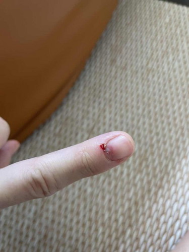 โดนหมาที่บ้านกัดเป็นแผล เคยฉีดพิษสุนัข