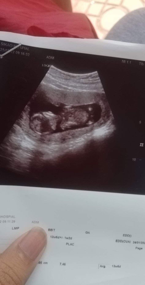 ปวดท้องน้อยด้านซ้าย