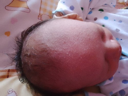 Info obat untuk anak yang baru lahir yang terkena ruam keringat buntet