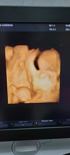 Bun mau tanya, ini hasil usg 6 bulan. Kenapa bentuk kepala nya gtu ya bun, agak khawatir. Ada yg tau