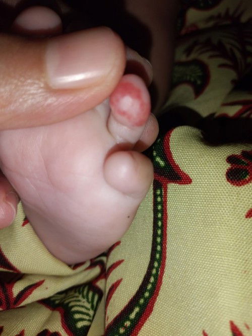 Ujung jari kaki merah