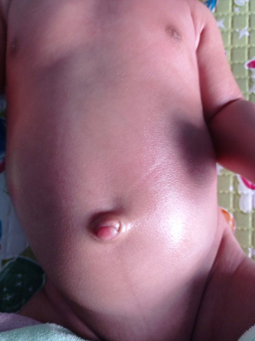 Bentuk puser bayi