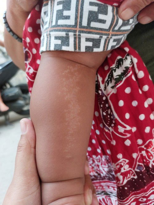 Bintik putih di kaki