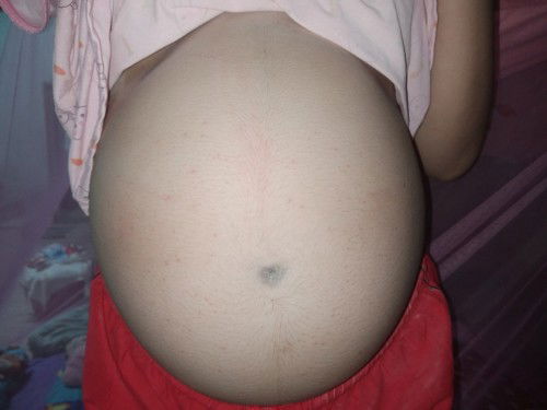 ท้อง28สัปดาห์ ผื่นขึ้น คันมาก