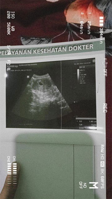 Hamil 5w tapi baru ada kantung kehamilan aja.