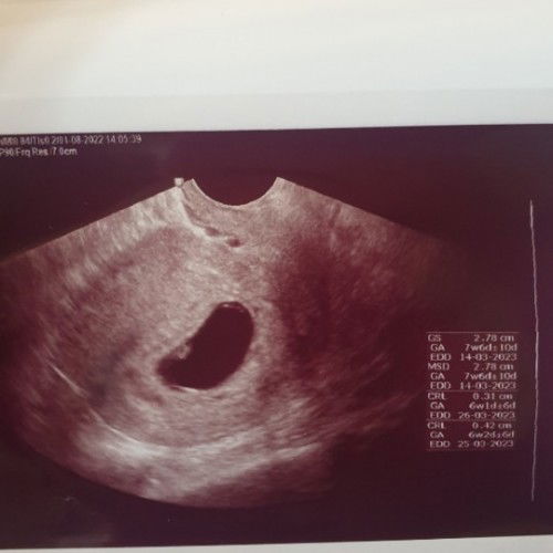 Sharing ,yuk rajin usg di tm1 demi tau perkembangan janin