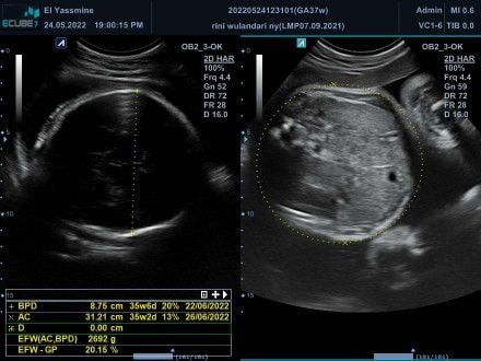 Bayiku meninggal saat dilahirkan