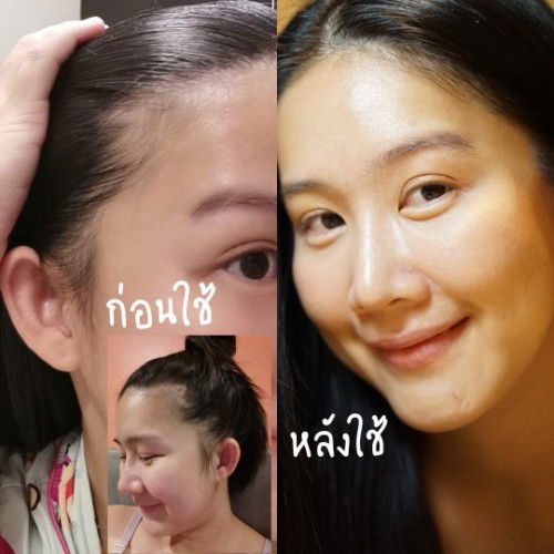ป้ายยา แม่ๆหลังคลอดที่​มีปัญหา​ผมร่วง ผมบาง ผมไม่ขึ้นใหม่ค่ะ