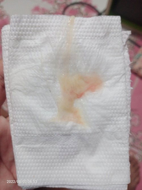 แบบนี้ใช่มูกเลือดมั้ยคะ