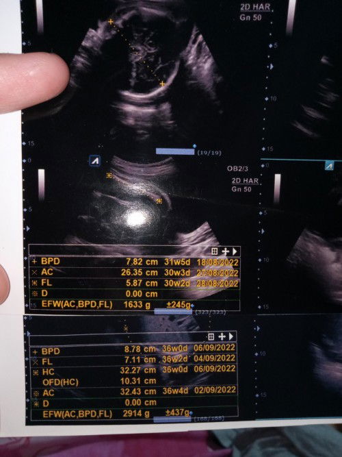 TENTANG HPL dan USIA JANIN