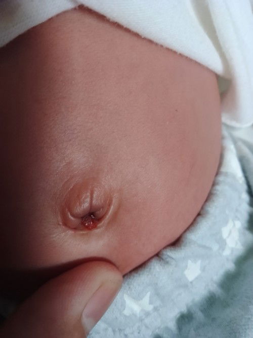 Sinong naka experience nang ganito sa navel nang baby, newborn.