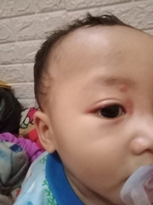 Bintik bernanah pada bayi