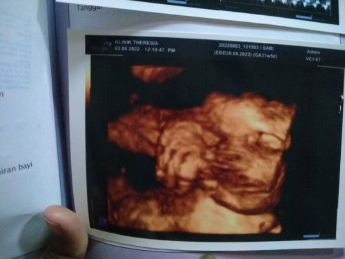 Kepala masuk panggul