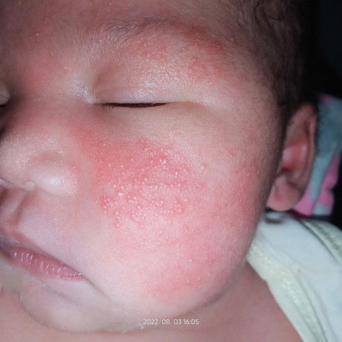 Mawawala po ba tong Rushes ni baby sa muka nya? 5days old po.