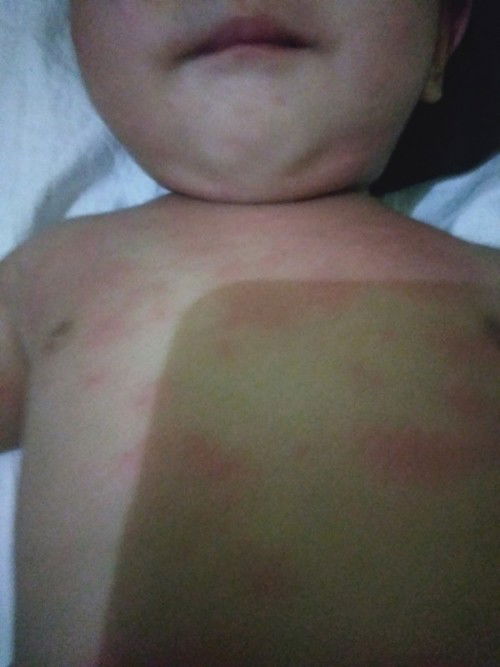 Allergy po ba or rashes?