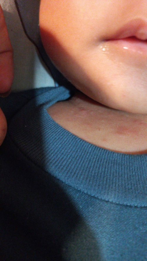 Bintik" merah pada bayi.. Minta solusi nya bun.