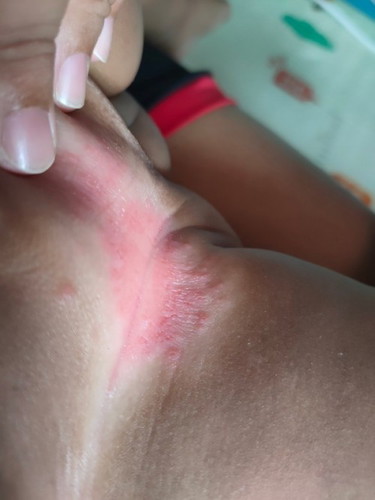 ขอปรึกษาแม่ๆหน่อยค่ะลูกเป็นผื่นแดงตรงง่ามขาไม่หายสักทีเป็นตั้งแต่เข้า4เดือนจนตอนนี้จะเข้า10เดือนแล้ว