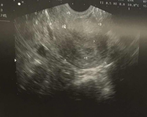 Ultrasound