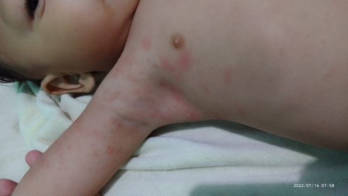 Ada yg pernah ngalamin hal kaya gini bund?
Sudah ke dokter dan di kasih Salep, tp blm sembuh?