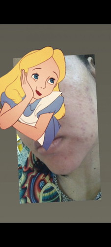 Muka breakout teruk..