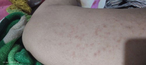 Masuk 37 week gatal semua