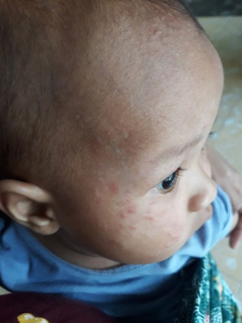 Bintik merah di wajah