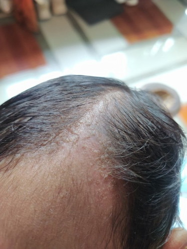 Is this cradle cap?
