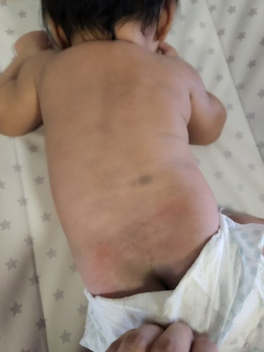 Baby bruises from birth