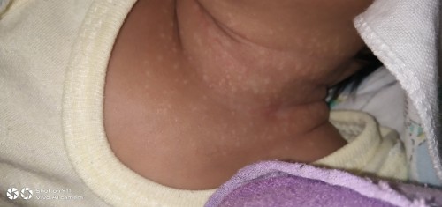 Rashes ni baby sa leeg