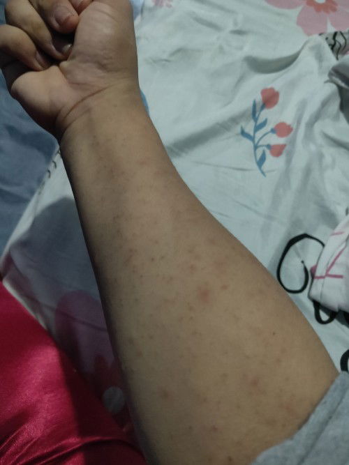 SKIN RASHES AFTER GIVING BIRTH