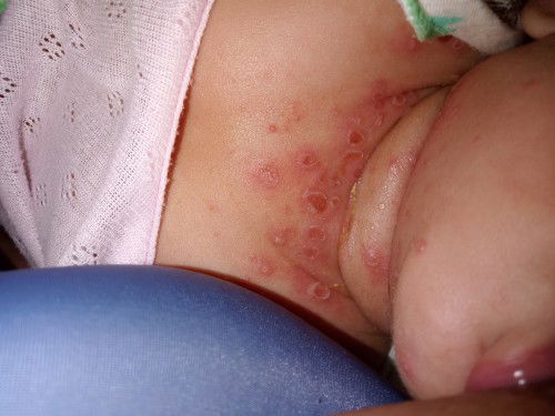 Leher bayi seperti cacar berair