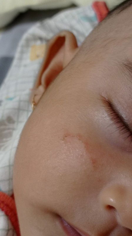 Bintik-bintik merah pada wajah bayi 2 bulan